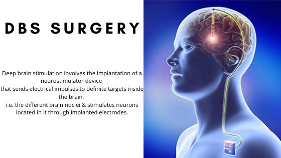 DBS surgery