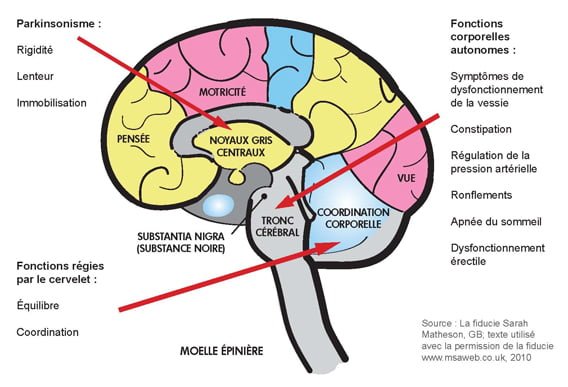 Atrophie Multisystématisée