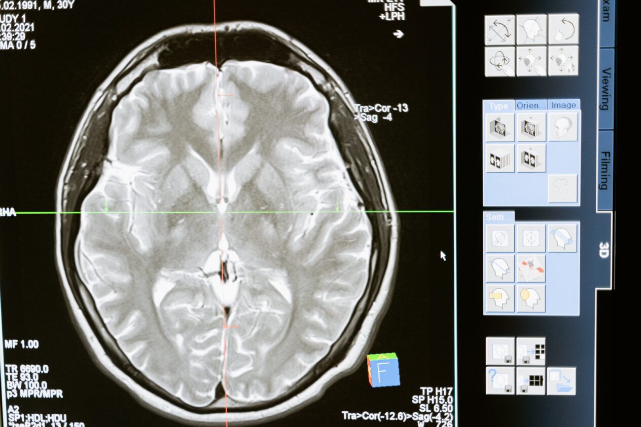 Transcranial Focused Ultrasound: “Opening” the door to the Blood Brain Barrier